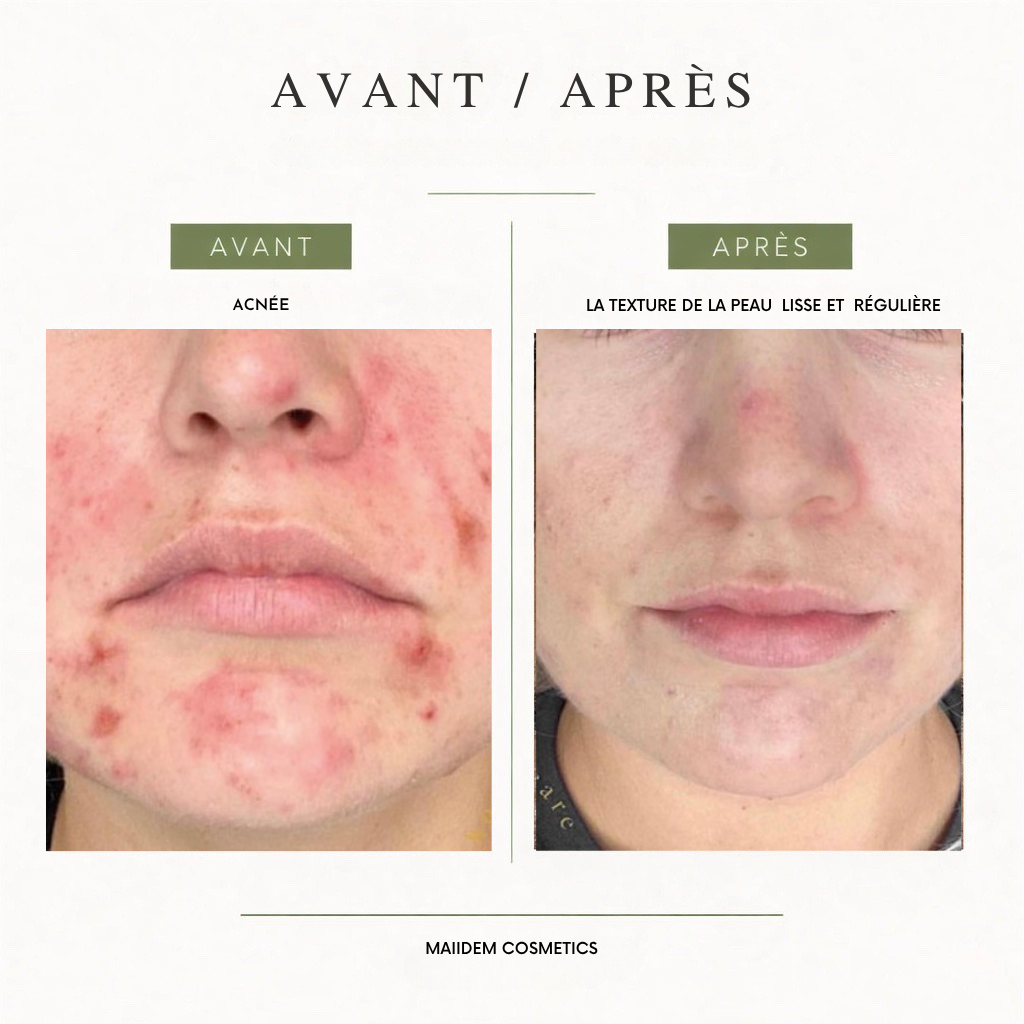 Routine anti-inflammatoire