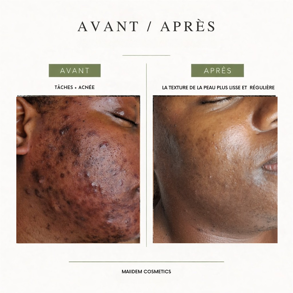 Routine correction anti-inflammatoire et anti-tâches