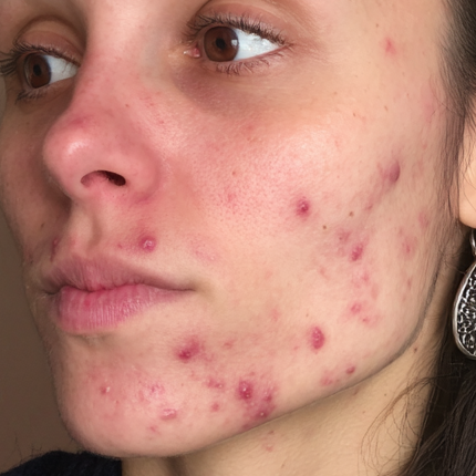 Imperfections & acné